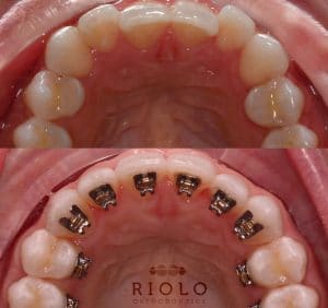 Hidden Lingual Braces: Incognito Treatment Behind Teeth