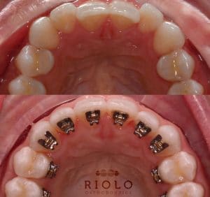 Columbus Hidden / Lingual Braces