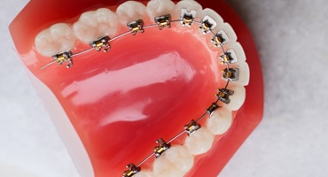 Get Lingual Braces in Mount Dora, FL